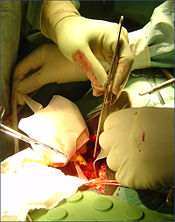 Kidney Transplant